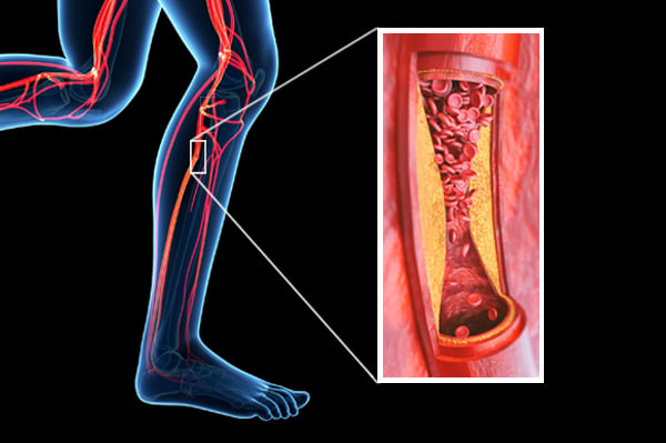 what-does-pad-stand-for-in-medical-terms